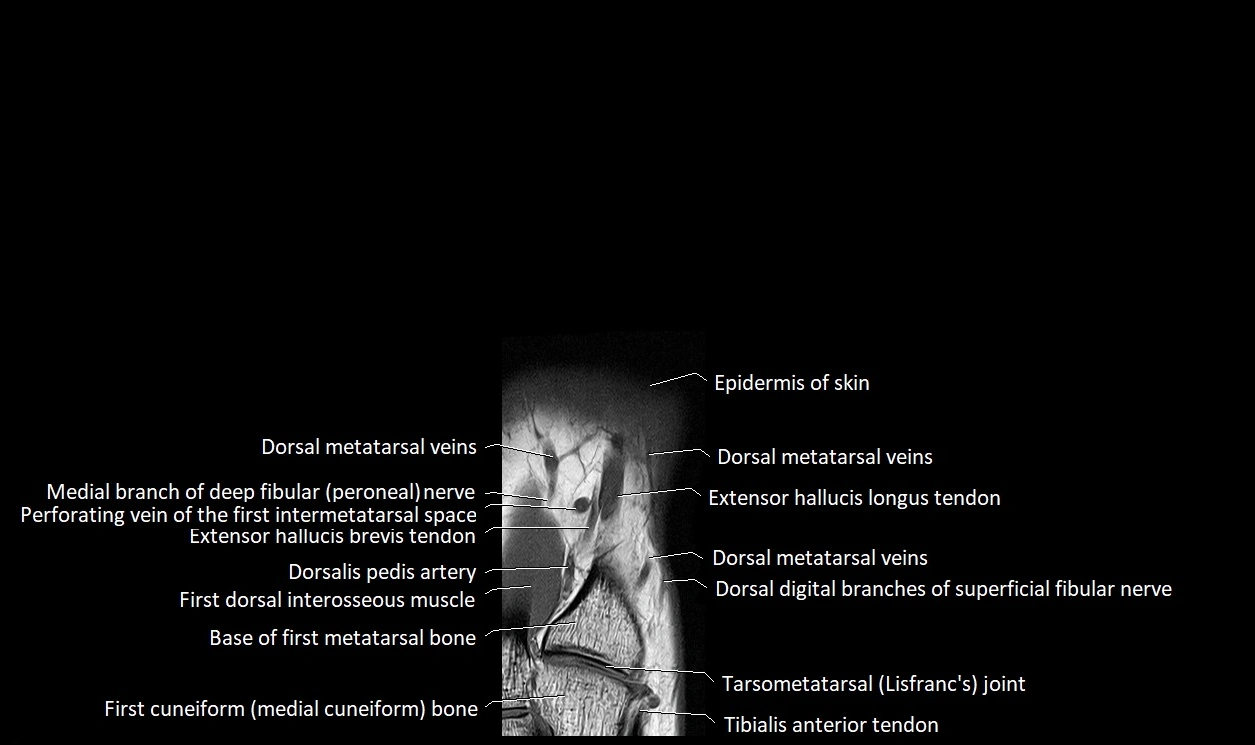 Great Toe micro anatomy MRI axial cross sectional 3T image 7.webp